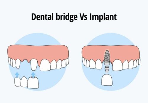 How Dental Bridges Replace Missing Teeth in Brentwood