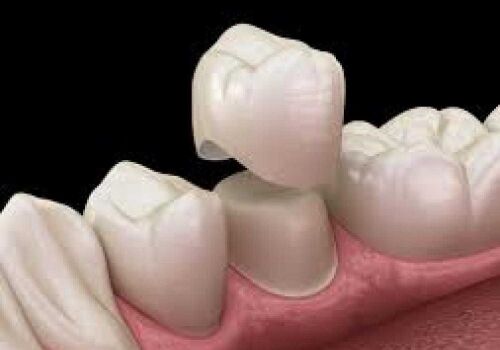Saving Damaged Teeth: 5 Benefits of Dental Crowns