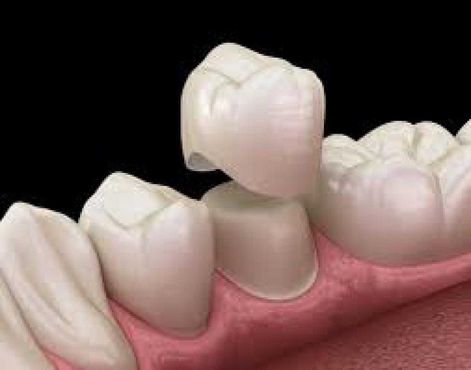 Saving Damaged Teeth: 5 Benefits of Dental Crowns