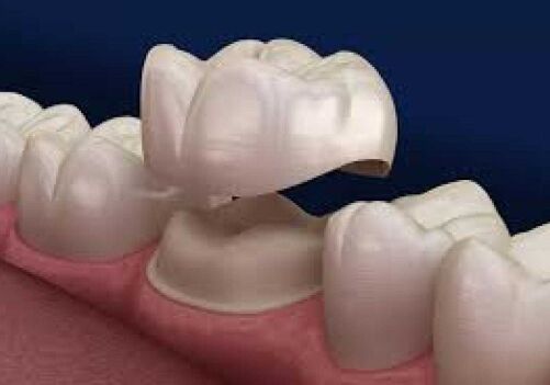 Saving Damaged Teeth: 5 Benefits of Dental Crowns