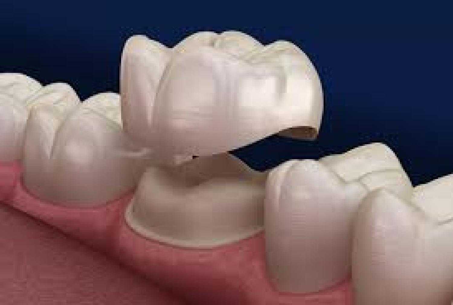 Cavities Chewing ability Crown types Dental anxiety Dental complications Dental health Dental Implants Dentist in Brentwood Patient testimonials Pulp cleaning Root canal symptoms Routine check-ups Teeth Cleaning Tooth decay Tooth Extraction Tooth infection Tooth replacement Brentwood dentist Saving Damaged Teeth: 5 Benefits of Dental Crowns