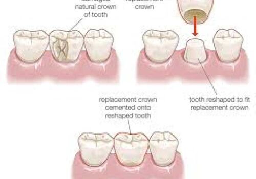 Saving Damaged Teeth: 5 Benefits of Dental Crowns