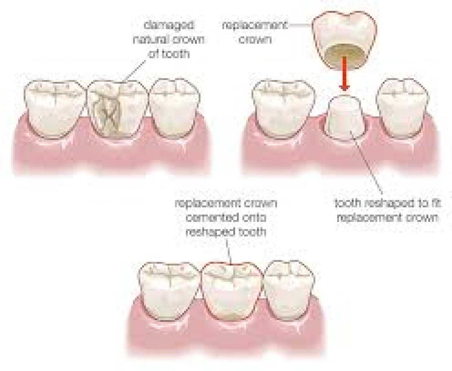 Saving Damaged Teeth: 5 Benefits of Dental Crowns