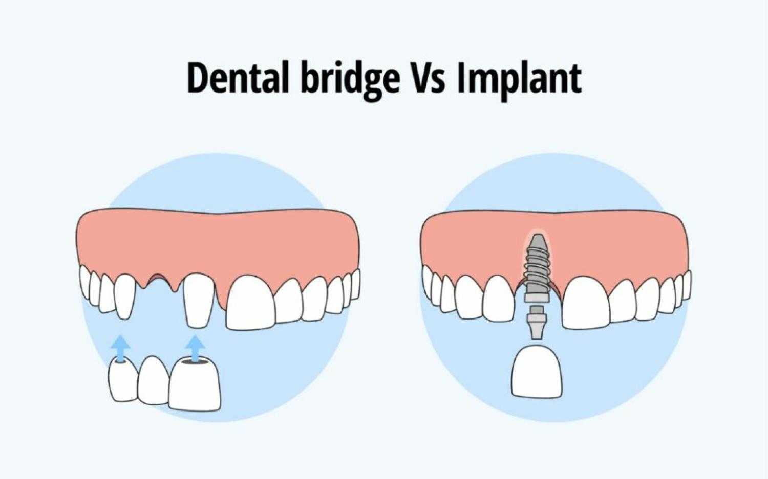 How Dental Bridges Replace Missing Teeth in Brentwood