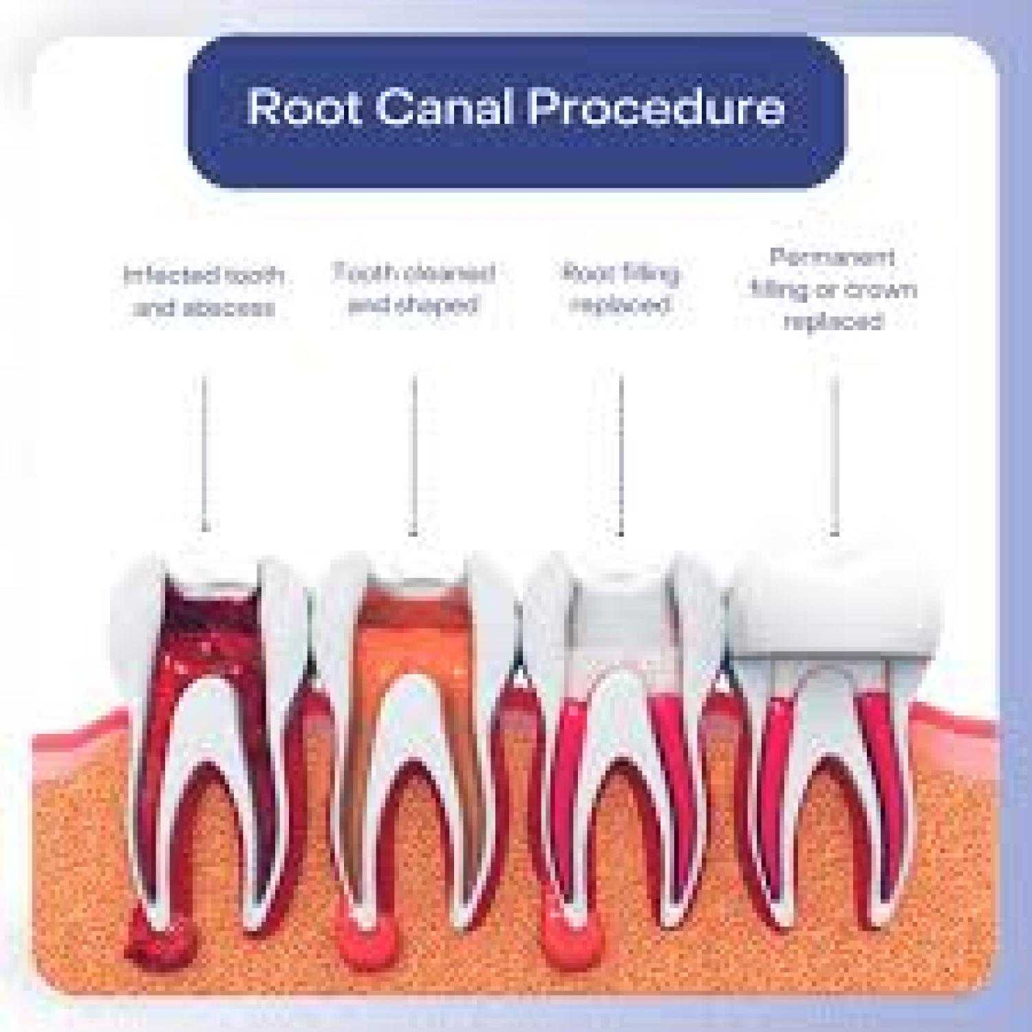 Dr. Ton's Expert Touch: Root Canal Treatment Explained