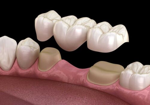 How Dental Bridges Replace Missing Teeth in Brentwood