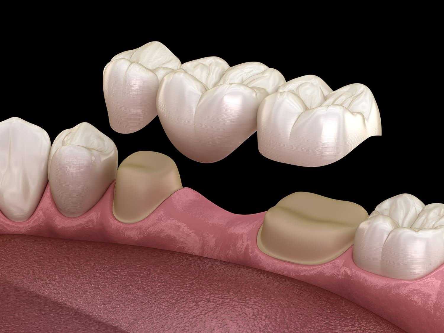 Extraction Dentist How Dental Bridges Replace Missing Teeth in Brentwood