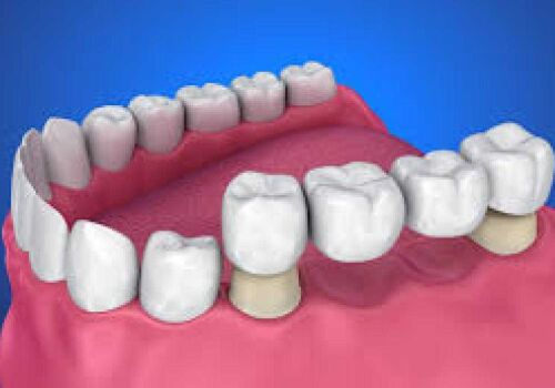 How Dental Bridges Replace Missing Teeth in Brentwood