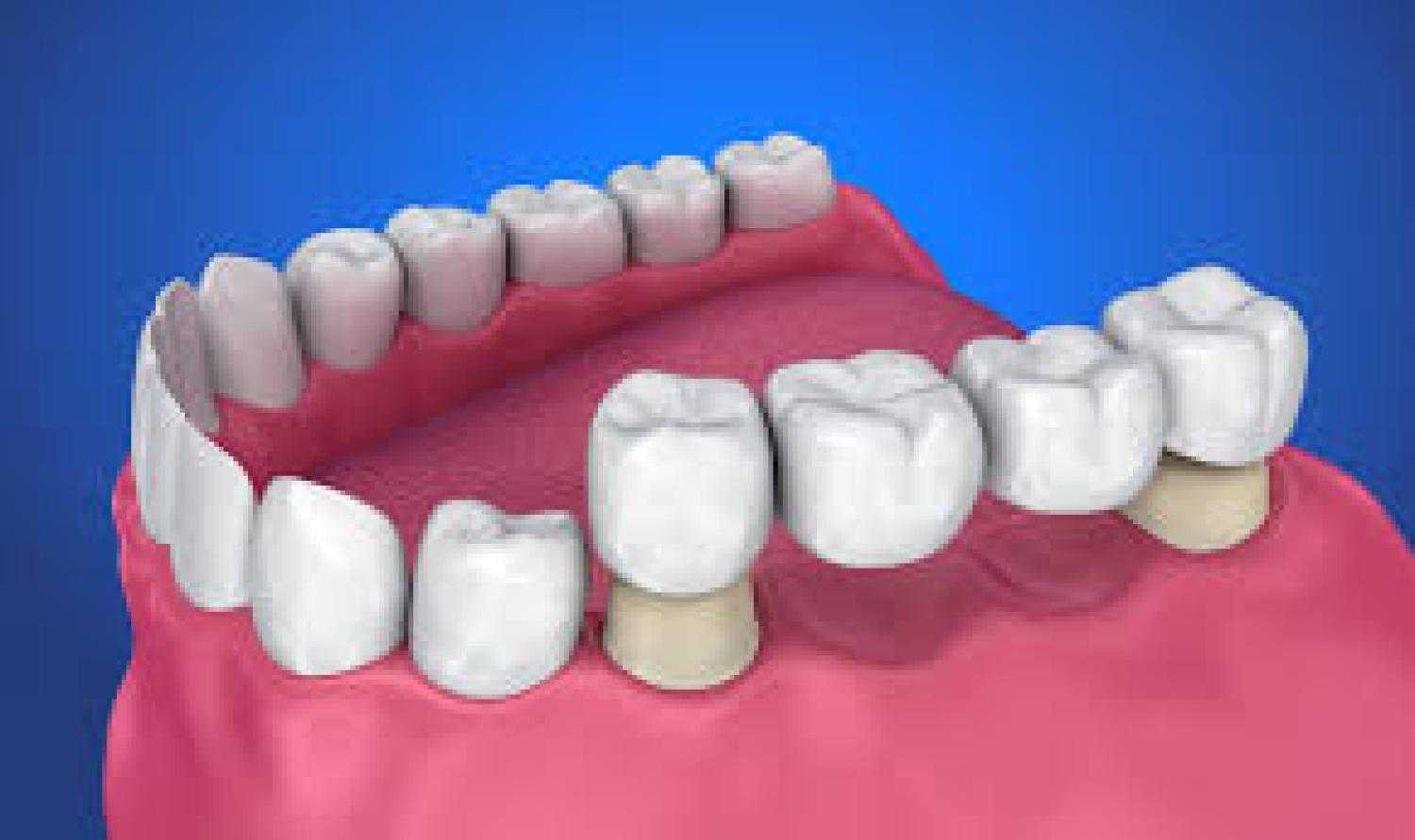 How Dental Bridges Replace Missing Teeth in Brentwood