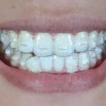Implant dentist, cosmetic, teeth cleaning, brentwood