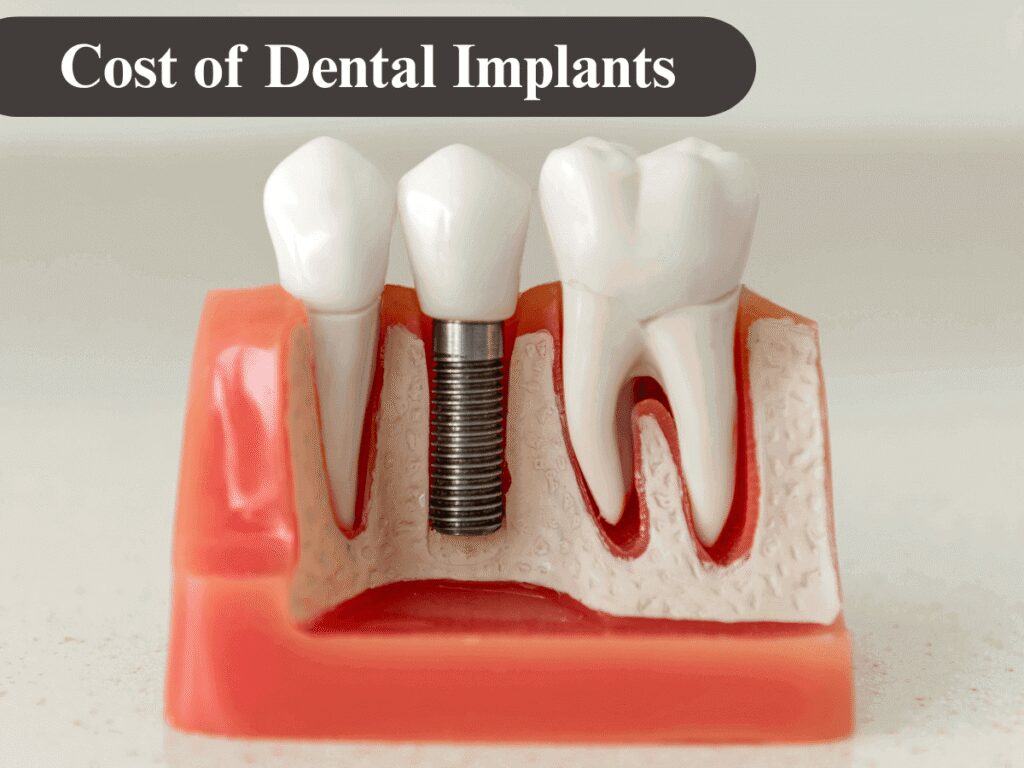 Cost of Dental Implants In California
