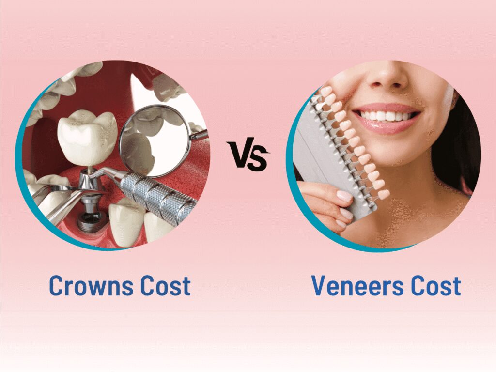 Crowns vs Veneers Cost