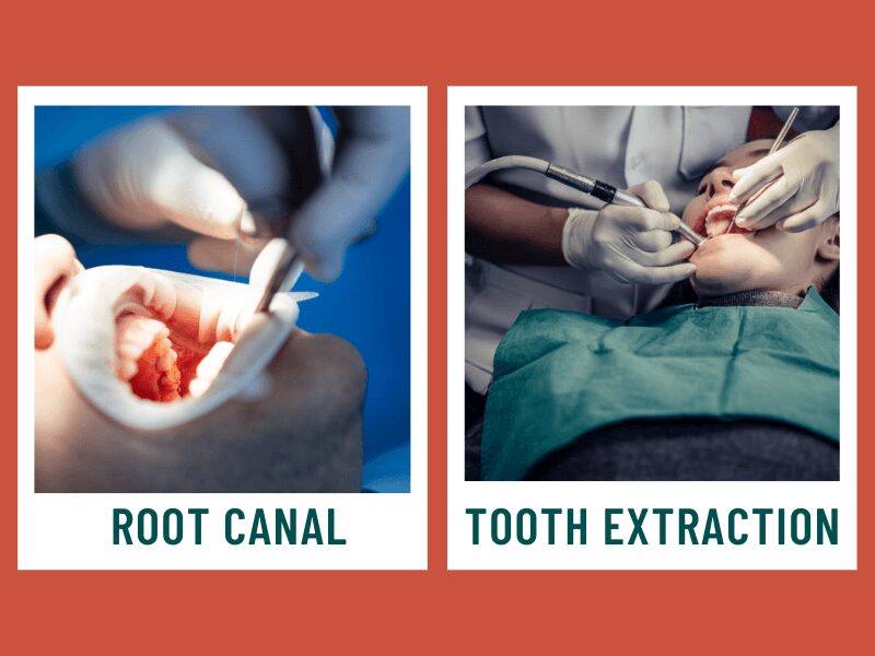 Root Canal vs Tooth Extraction: Which Should You Choose?